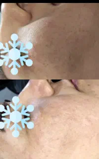 پاکسازی تخصصی پوست (با دستگاه)