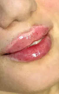 تخفیفات ویژه در تزریق فیلر و بوتاکس