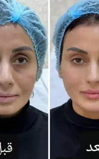 فیلرلب خط خنده فول فیس مزو نیدیلینگ prp بوتاکس