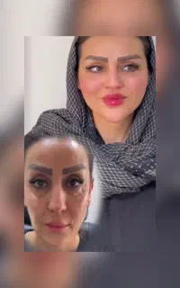 ژل لب / فول فیس / فیلر گونه / تخفیفات طلایی / پزشک