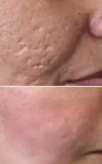 آفر لیزر  کربوکسی co2 رفع جوش،زخم،بخیه کل صورت