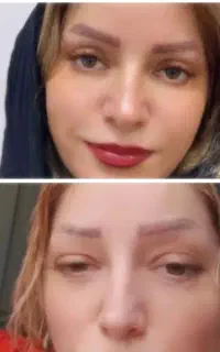 بلفاروپلاستی،لیفت شقیقه،دایرکت ابرو
