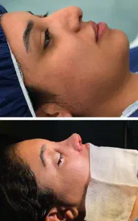 جراحی بینی اقساط بدون سود