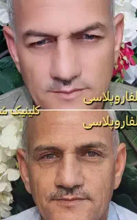 عمل جراحی پلک(بلفاروپلاسی)جراحی گوش(اتوپلاسی)