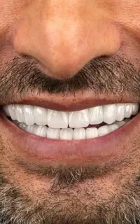 دندانپزشکی، ایمپلنت تخفیف ویژه به مدت محدود