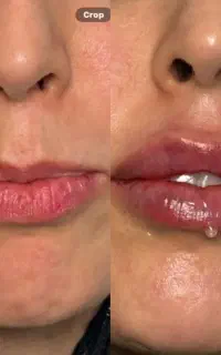 بوتاکس ژل فیلر