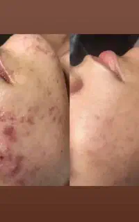 لیزر مو مزونیدلینگ مزوتراپی هایفو تراپی جوانساز