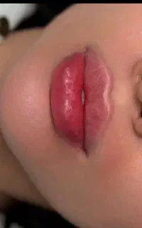 تخفیف ۳۰ درصدی اموزش وانجام خدمات ژل بوتاکس