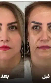 جشنواره بهاره لیفت هایفو با لیزر و ۱۰ هدیه رایگان