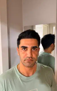 کاشت مو و ابرو طبیعی