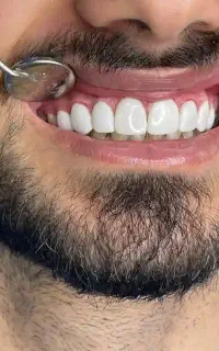 دندانپزشکی روکش زیرکونیا واحدی ۴ میلیون