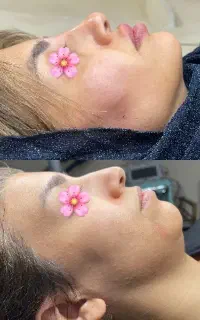 قبل و بعدژل، بوتاکس، فیلر، بصورت تخصصی و تضمینی