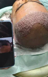 کاشت مو و ابرو پناه با تخفیف ویژه