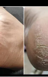 کرم ترک پا خداحافظی با خشکی و ترک پا