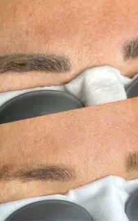 پاک‌کردن تتو ابرو و بدن با لیزر توسط پزشک