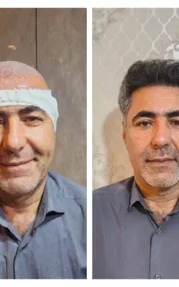 کاشت مو باشرایطی که نباید ازدست بدی