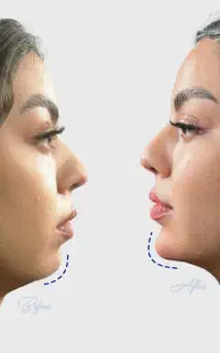 تخفیفات فقط امروز (تزریق توسط پزشک متخصص)
