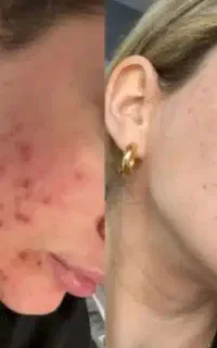 پی ار پی prp، جوانساز روشن کننده رفع لک صورت 300