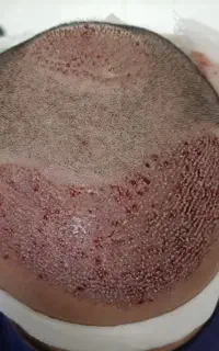 آموزش کاشت مو