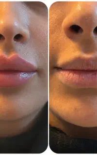تزریق بوتاکس ژل فیلر بادی لب کانتورینگ لیفت صورت