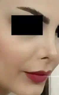 جراحی زیبایی عمل بینی ۳۵ لیپو ابدو 85لیفت 70 مامو