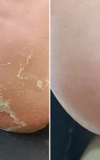 کف سابی تخصصی ترک های عمقی با تغیر در یک جلسه