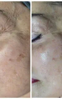 تخفیف ویژه پاکسازی و فشیال