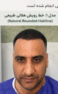 کاشت مو و ابرو تضمینی فقط ۲۰ تومان بهمراه دارو
