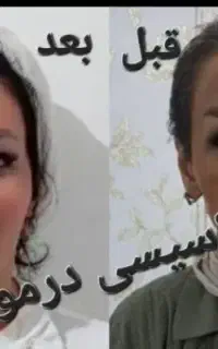 ژل و بوتاکس