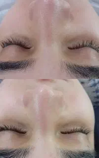 کاشت مژه موقت پاکسازی صورت