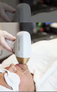 جشنواره لیزر موهای زائد بدون درد (بانوان )