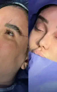 جراحی لیفت شقیقه‌ بلفارو‌ دایرکت غبغب سانترال پانچ