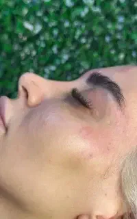 تزریق فیلر و ژل بوتاکس ولیزرموی زائدفول بادی