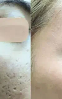 درمان تخصصی در یک جلسه اسکار آکنه و جای جوش