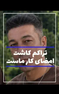 تخفیف پاییزه قویترین تیم کاشت مو و ابرو در اهواز