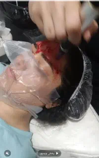 میکرونیدلینگ صورت و فیشیال