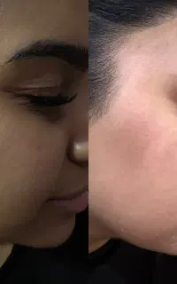 پاکسازی (فیشیال  )مزونیدلینگ پوست کره ای تخفیف50%