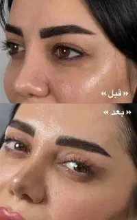 افتادگی پلک  بابخیه لیزری توسط متخصص چشم