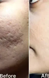 خداحافظی با کک ومک ولک وجای جوش وبخیه