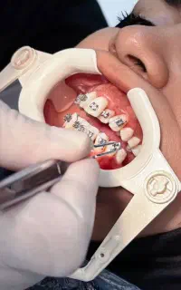 ارتودنسی با حداقل پیش پرداخت