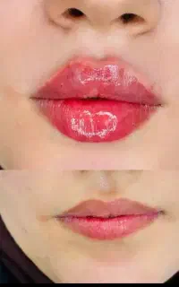 ژل لب وبوتاکس