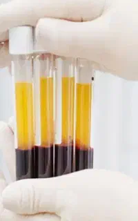 نمونه گیری و آماده سازی پلاکت برای PRP
