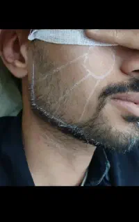 آموزش و تزریق ژل بوتاکس مزو به قیمت باور نکردنی