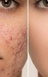 (پک رفع منافذبازپوست روشن کننده و ضدلک )
