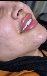 تخفیف ویژه  فیلرلب و .. برند کره ای اصل چکی