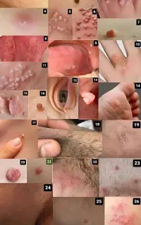 رفع ریشه ای زگیل و تبخال تناسلی