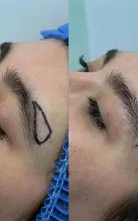 جشنواره بلفاروپلاسی و دایرکت لیفت ابرو