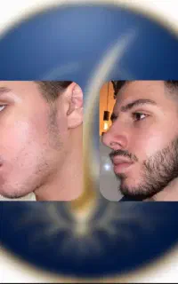 رویش ریش و مو سی روزه