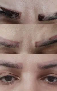 تخفیف ریموو تخصصی/خدمات ارایش دائم