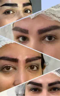 کاشت ابرو دائمی در رشت-پرداخت دومرحله ای